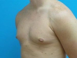 Gynecomastia Before and After Pictures Fort Lauderdale, FL