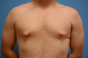 Gynecomastia Before and After Pictures Fort Lauderdale, FL