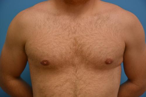 Gynecomastia Before and After Pictures Fort Lauderdale, FL