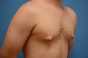 Gynecomastia Before and After Pictures Fort Lauderdale, FL