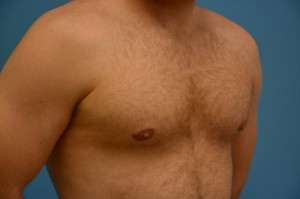 Gynecomastia Before and After Pictures Fort Lauderdale, FL