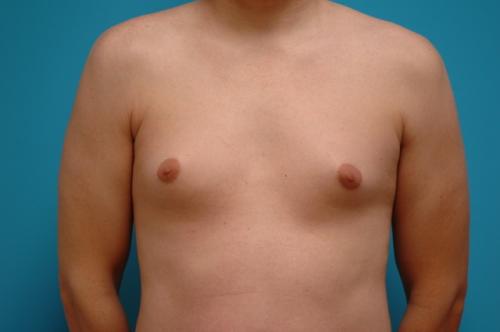 Gynecomastia Before and After Pictures Fort Lauderdale, FL