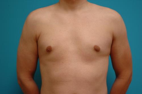 Gynecomastia Before and After Pictures Fort Lauderdale, FL