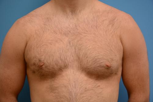 Gynecomastia Before and After Pictures Fort Lauderdale, FL