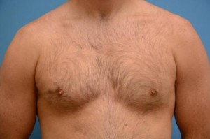 Gynecomastia Before and After Pictures Fort Lauderdale, FL