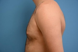 Gynecomastia Before and After Pictures Fort Lauderdale, FL