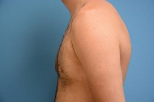 Gynecomastia Before and After Pictures Fort Lauderdale, FL