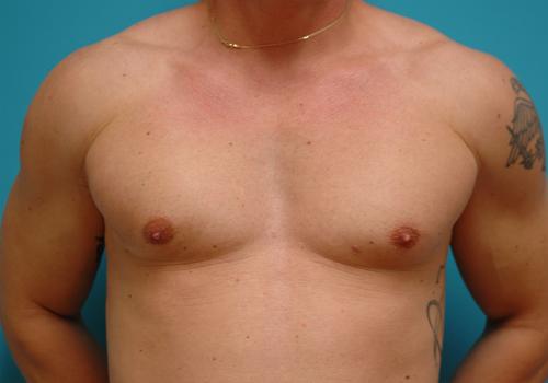 Gynecomastia Before and After Pictures Fort Lauderdale, FL