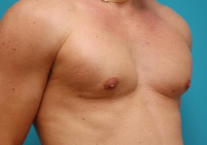 Gynecomastia Before and After Pictures Fort Lauderdale, FL