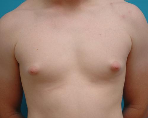 Gynecomastia Before and After Pictures Fort Lauderdale, FL