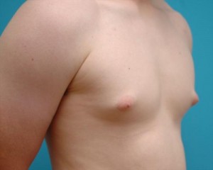 Gynecomastia Before and After Pictures Fort Lauderdale, FL