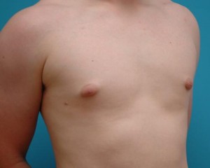 Gynecomastia Before and After Pictures Fort Lauderdale, FL