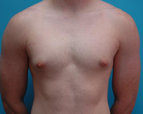 Gynecomastia Before and After Pictures Fort Lauderdale, FL