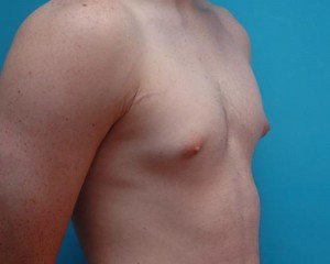 Gynecomastia Before and After Pictures Fort Lauderdale, FL