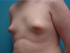 Gynecomastia Before and After Pictures Fort Lauderdale, FL