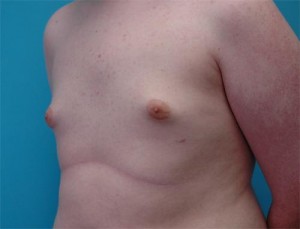 Gynecomastia Before and After Pictures Fort Lauderdale, FL