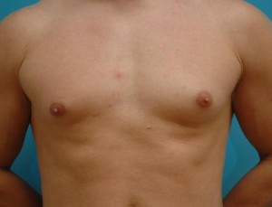 Gynecomastia Before and After Pictures Fort Lauderdale, FL