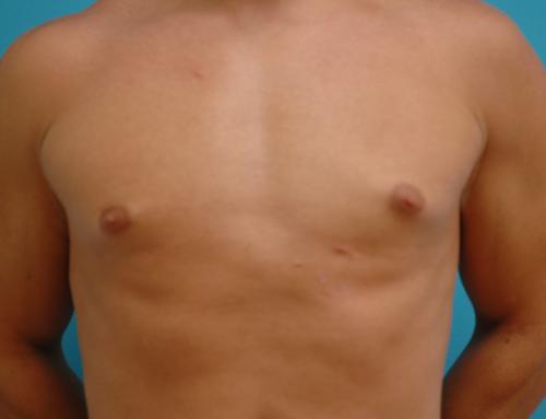 Gynecomastia Before and After Pictures Fort Lauderdale, FL