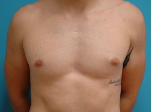 Gynecomastia Before and After Pictures Fort Lauderdale, FL