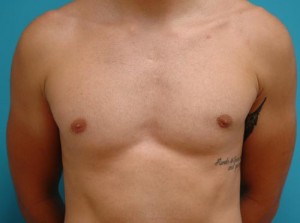 Gynecomastia Before and After Pictures Fort Lauderdale, FL