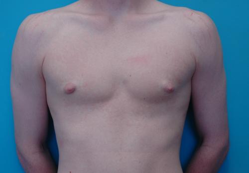 Gynecomastia Before and After Pictures Fort Lauderdale, FL