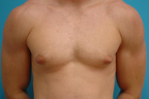 Gynecomastia Before and After Pictures Fort Lauderdale, FL