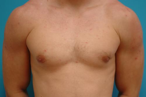 Gynecomastia Before and After Pictures Fort Lauderdale, FL