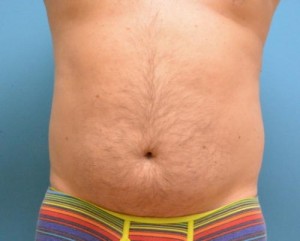 Male Liposuction Before and After Pictures Fort Lauderdale, FL