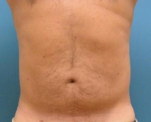 Male Liposuction Before and After Pictures Fort Lauderdale, FL