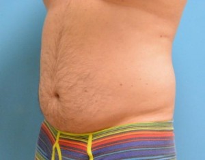 Male Liposuction Before and After Pictures Fort Lauderdale, FL