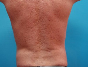 Male Liposuction Before and After Pictures Fort Lauderdale, FL