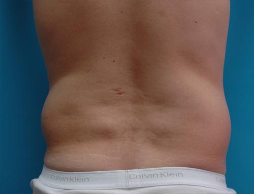 Male Liposuction Before and After Pictures Fort Lauderdale, FL