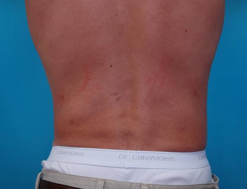 Male Liposuction Before and After Pictures Fort Lauderdale, FL