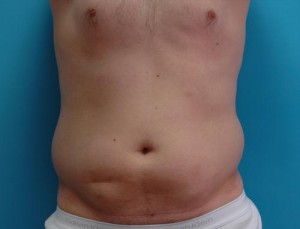 Male Liposuction Before and After Pictures Fort Lauderdale, FL