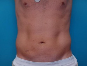 Male Liposuction Before and After Pictures Fort Lauderdale, FL