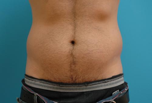 Male Liposuction Before and After Pictures Fort Lauderdale, FL