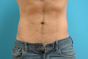 Male Liposuction Before and After Pictures Fort Lauderdale, FL