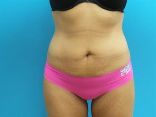 Mini Tummy Tuck Before and After Pictures Fort Lauderdale, FL