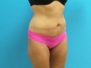 Mini Tummy Tuck Before and After Pictures Fort Lauderdale, FL