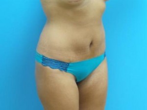 Mini Tummy Tuck Before and After Pictures Fort Lauderdale, FL