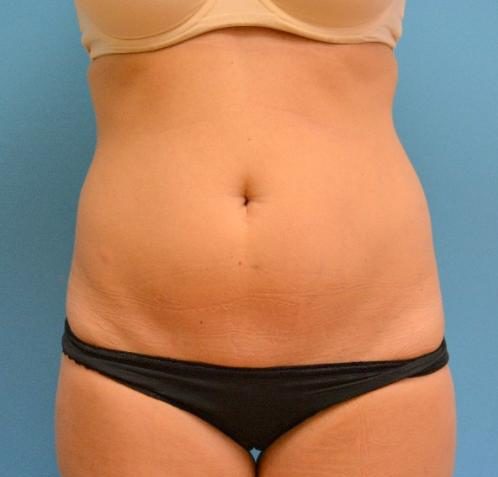 Mini Tummy Tuck Before and After Pictures Fort Lauderdale, FL