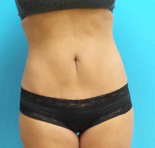 MiniTummyTuck-06 Mini Tummy Tuck Before and After Pictures Fort Lauderdale, FL