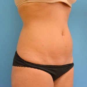 Mini Tummy Tuck Before and After Pictures Fort Lauderdale, FL