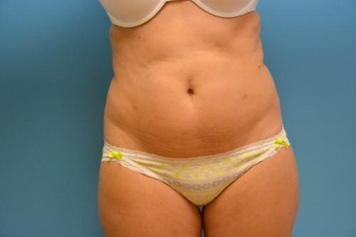 Mini Tummy Tuck Before and After Pictures Fort Lauderdale, FL