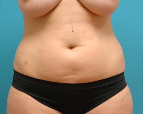 Mini Tummy Tuck Before and After Pictures Fort Lauderdale, FL