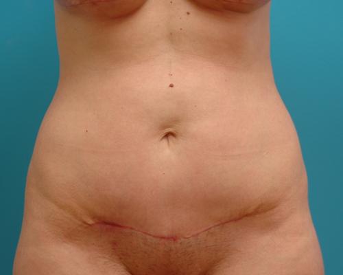 Mini Tummy Tuck Before and After Pictures Fort Lauderdale, FL