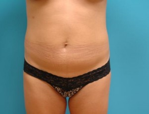 Mini Tummy Tuck Before and After Pictures Fort Lauderdale, FL