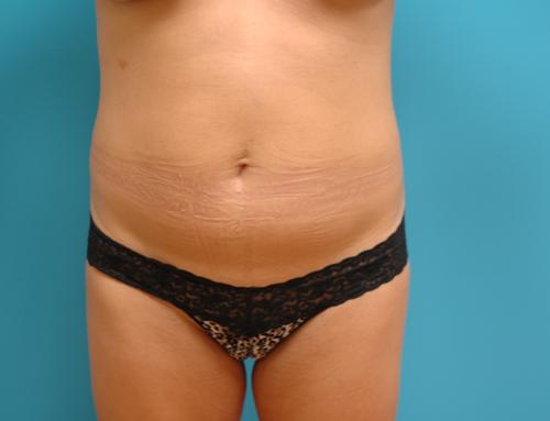 MiniTummyTuck-25 Mini Tummy Tuck Before and After Pictures Fort Lauderdale, FL