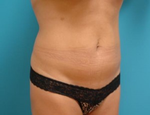 Mini Tummy Tuck Before and After Pictures Fort Lauderdale, FL