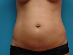 Mini Tummy Tuck Before and After Pictures Fort Lauderdale, FL